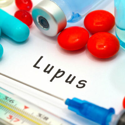 Lupus – Symptoms, Risk Factors, and Diagnosis